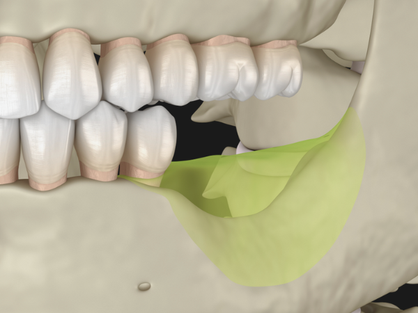 [ 마곡동치과_치아 상실 3 ] 이빨 빠지면 임플란트? 장점과 시기 쉽게 정리했습니다 관련 이미지 2