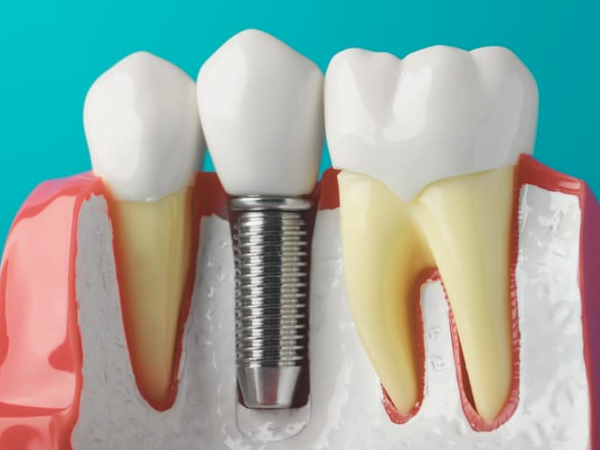 마곡동치과_2. 잇몸재생주사 PDRN, 효과를 기대해도 되는 경우 vs 어려운 경우 관련 이미지 3