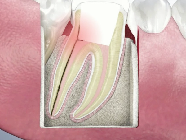 마곡역치과_ "신경치료 후 치아, 왜 꼭 &lsquo;씌워야&rsquo; 할까요?" [7. 크라운 보철의 중요성] 관련 이미지 3