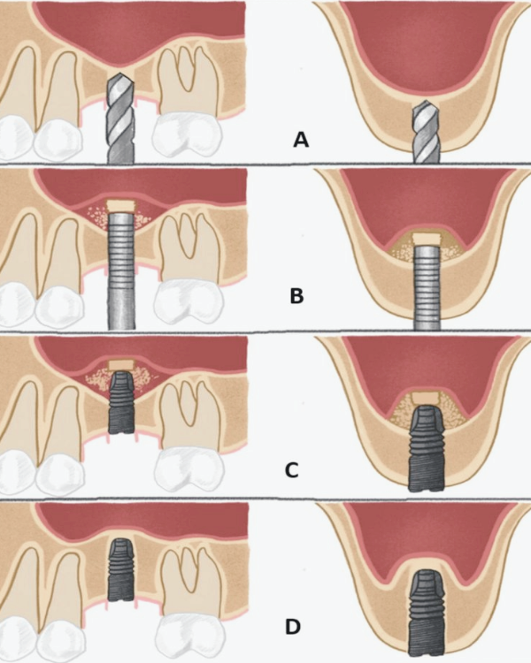 마곡역치과_2. 상악동 거상술 치조정 접근법, 언제 어떻게 진행될까? 관련 이미지 5