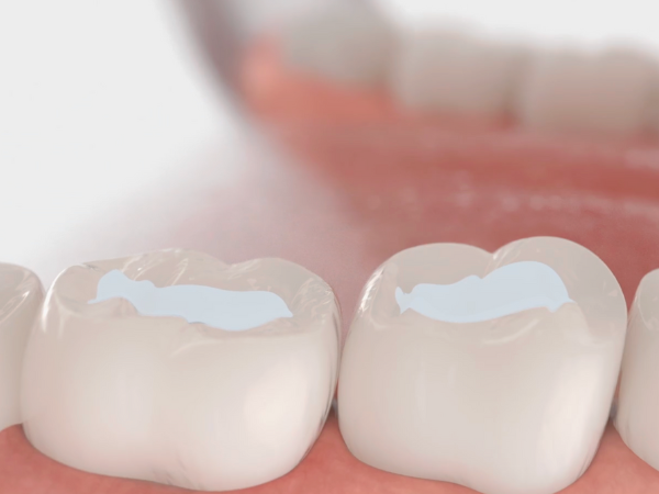 Magaok Station Dental Clinic_ &ldquo;It doesn’t hurt and it’s over quickly&rdquo; [3. Dental Sealant Procedure Process] image 5