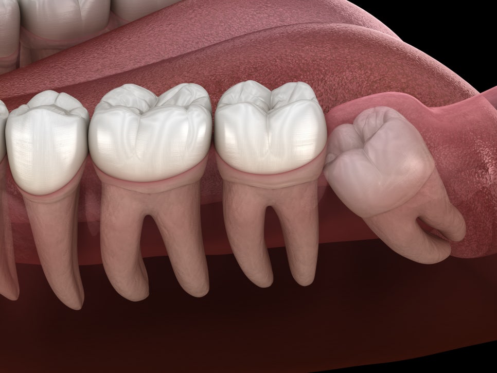 [ Magok Dental_01 ] Do wisdom teeth have to be removed no matter what? There are cases where extraction is not necessary image 3