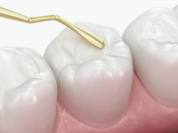 마곡역치과_1. 충치, 방치하면 어떻게 될까요? 레진부터 크라운까지 치료 단계 총정리 관련 이미지 2