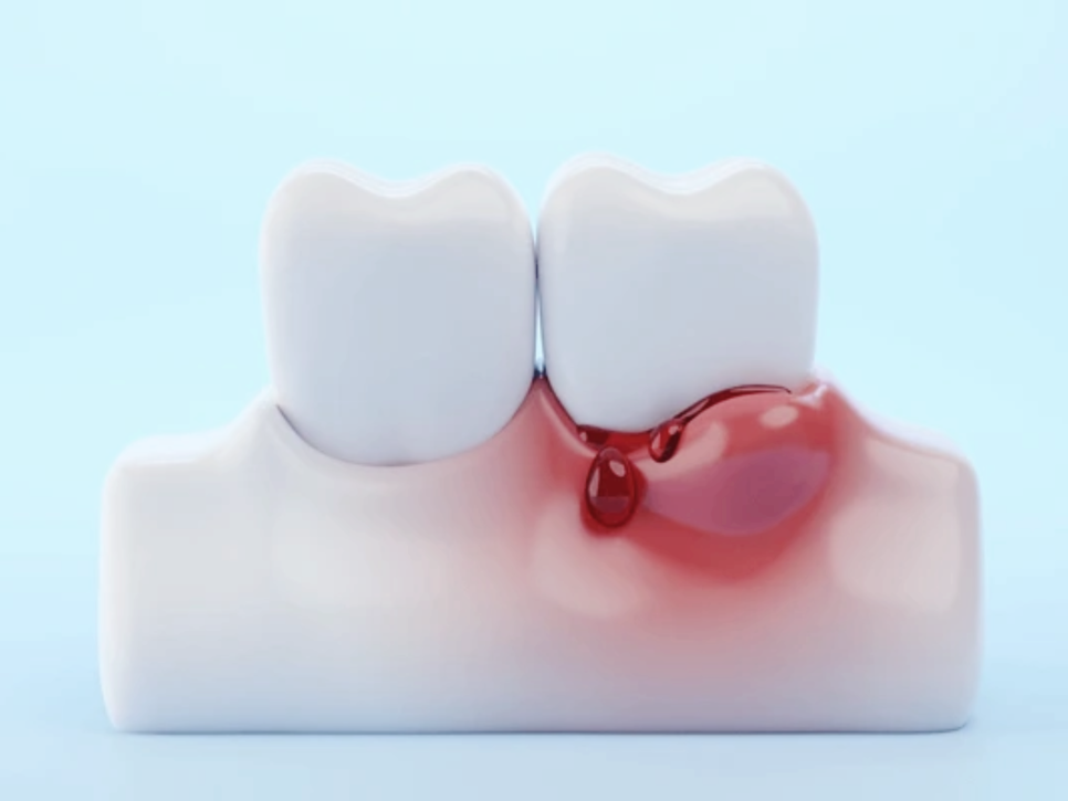 마곡역치과_&ldquo;괜찮겠지?&rdquo; 방심하다가 큰일! [ 1. 임플란트 주위염 3가지 증상 ] 관련 이미지 4