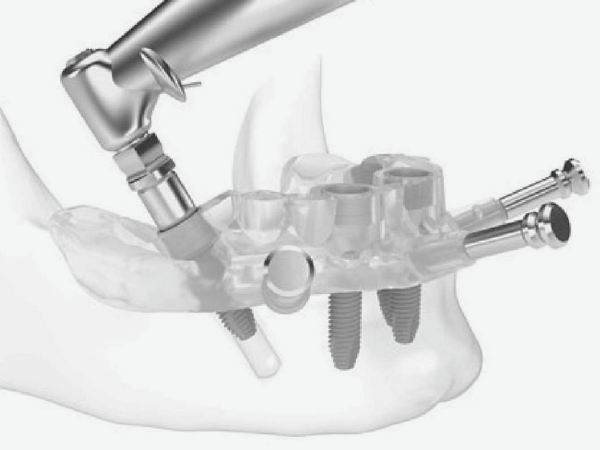 마곡동치과_&ldquo;왜 가격이 다를까?&rdquo;[4. 3D 네비게이션 임플란트 비용과 보험 그리고 선택기준] 관련 이미지 5