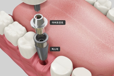 [ Magok Implants_07 ] Implant Prostheses: What’s the Difference Between Zirconia and PFM? image 2