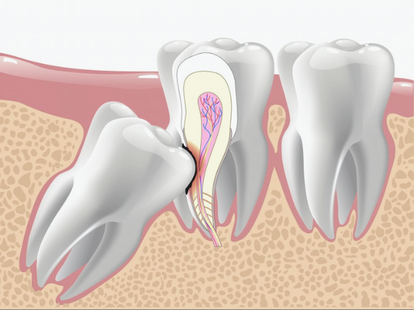 마곡동치과_2.사랑니 방치하면 어떻게 될까? 발치가 필요한 진짜 이유 4가지 관련 이미지 4