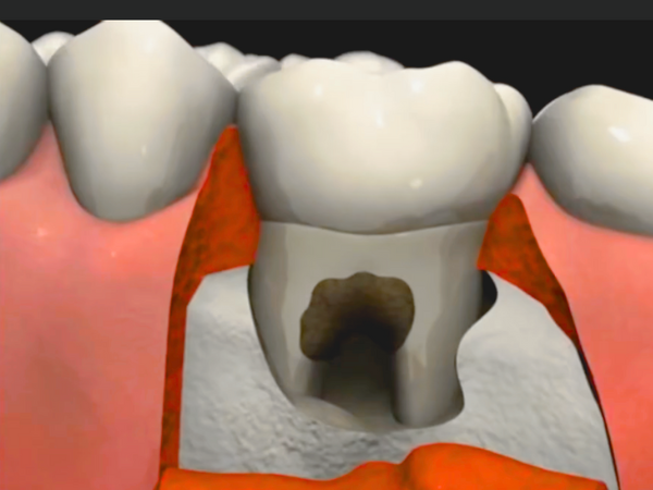 Maggok Dental_4. Is it over once the jawbone has melted away? How to save natural teeth with guided tissue regeneration (GTR) image 2