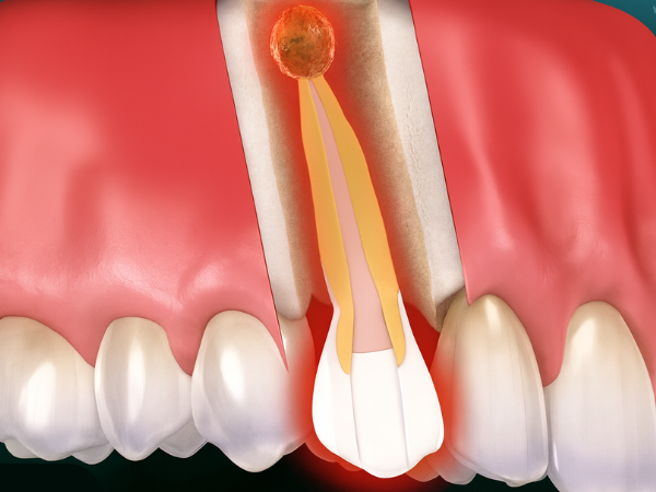 마곡동치과_&ldquo;그냥 두면 괜찮을 줄 알았죠?&rdquo; [3. 치근단절제술 미루면 생기는 문제] 관련 이미지 1