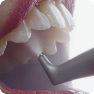 마곡치과_"스케일링에도 스타일이 있다?" [ 3. 에어플로우와 일반 스케일링 비교 ] 관련 이미지 4