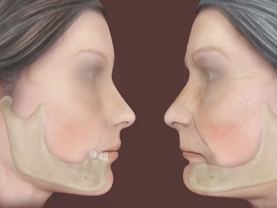 [ 마곡동치과_치아상실 5 ] 틀니, 실제로 써보면 어떤 느낌일까요? 관련 이미지 6