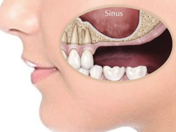 마곡역치과_1. 상악동거상술이란? 위턱 임플란트 전 꼭 알아야 할 정의와 적응증 관련 이미지 2