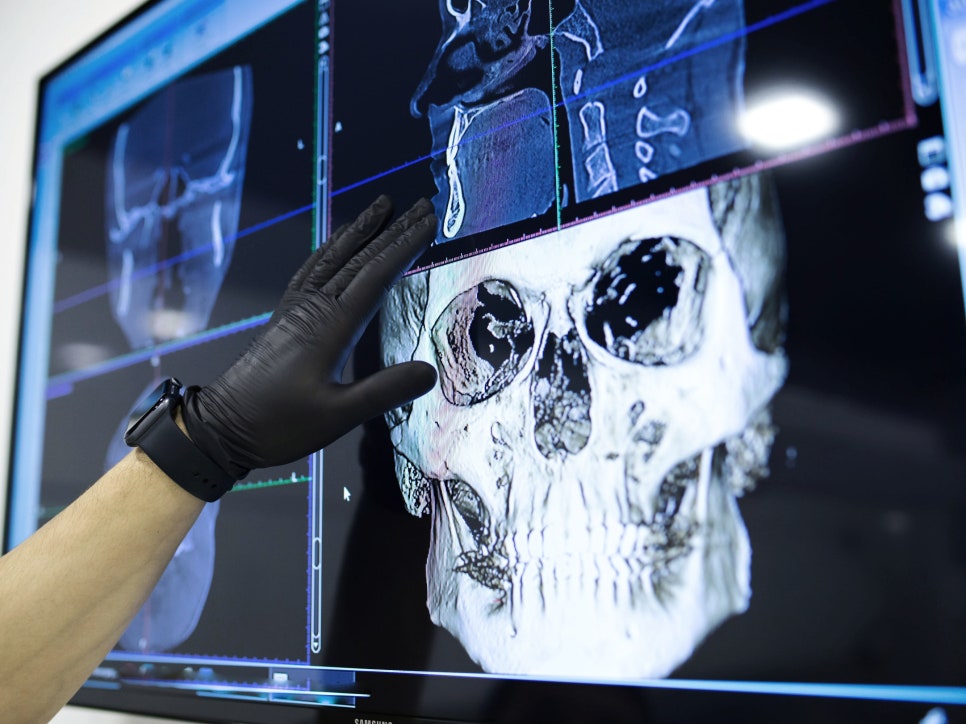 마곡동치과_1. 임플란트 치료에 관련 이미지 10