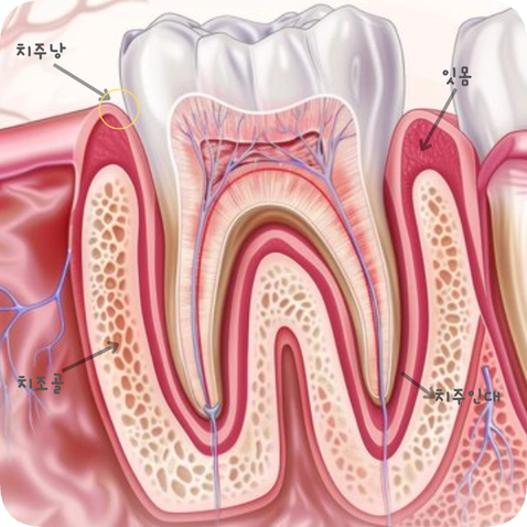 마곡동치과_1. 치주질환이란? (치은염과 치주염의 차이점) 관련 이미지 3
