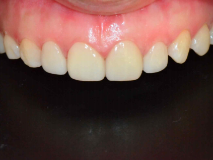 마곡역치과_4. 왜소치, 디아네이트 무삭제 라미네이트 케이스 관련 이미지 7