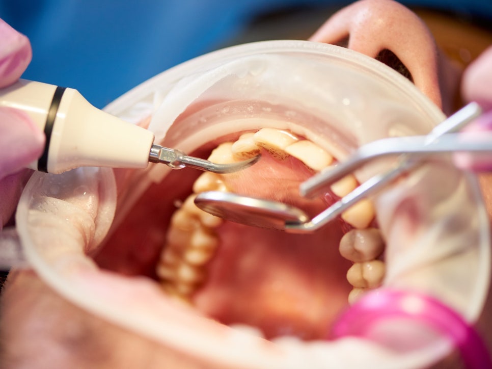 마곡동치과_ 2. 스케일링 주기와 소요 시간, 내 입속 상황에 맞게 꼭 알아야 할 포인트! 관련 이미지 3