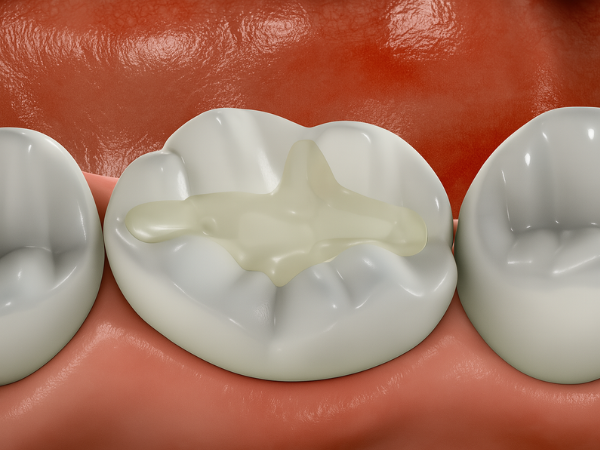 마곡동치과_ "치료가 끝났다고 안심은 금물!" [ 3. 신경치료 후 꼭 지켜야 할 6가지 주의사항] 관련 이미지 2