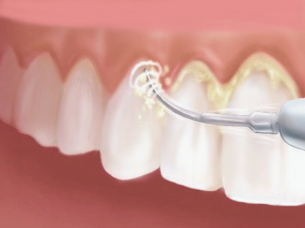 마곡동치과_4. 스케일링 오해와 진실? 치아 깎인다? 시리다? 진짜는 따로 있습니다. 관련 이미지 1