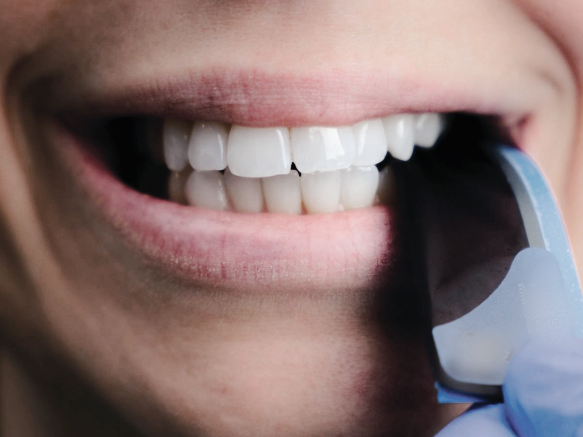 마곡역치과_&ldquo;치아는 살리고 충치만 잡는다" [ 어금니 레진 치료 과정 ] 관련 이미지 6