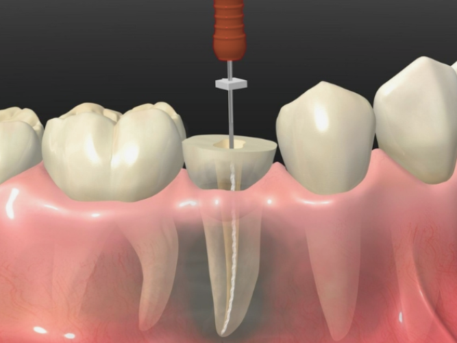 마곡역치과_ "안 아프다고 멈추면 더 위험해요!" [ 5. 신경치료 중단 시 생기는 문제들 ] 관련 이미지 2