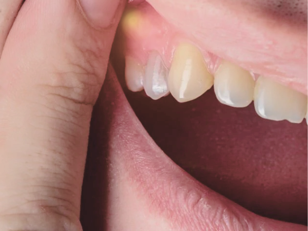 마곡동치과_&ldquo;이건 단순한 붓기가 아닙니다!" [ 2. 잇몸 고름 주머니 증상 ] 관련 이미지 2