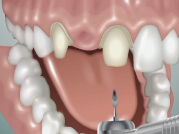 [ 마곡동치과_치아 상실 4 ] 브릿지 치료, 빠르게 해결 가능하지만 괜찮을까요? 관련 이미지 3
