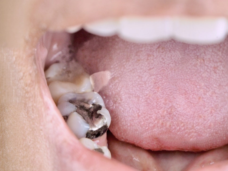 마곡치과_1. 아말감 충전, 아직 있어도 괜찮을까요? 수은 걱정에 대한 현실 답변 관련 이미지 1