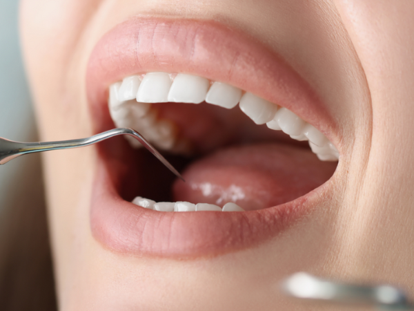 마곡역치과_5. 글래스아이오노머(GI) 치료 후 주의사항 관련 이미지 4