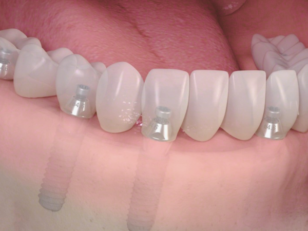 Magok-dong Dental Clinic_4. Full-Mouth Implant Surgery Process: A Step-by-Step Look image 6