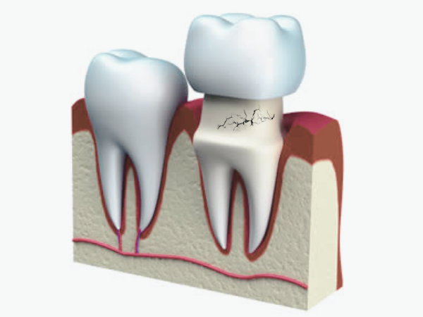 마곡역치과_4. 크라운 치료 후 통증? 불편감이 생기는 8가지 이유 관련 이미지 6