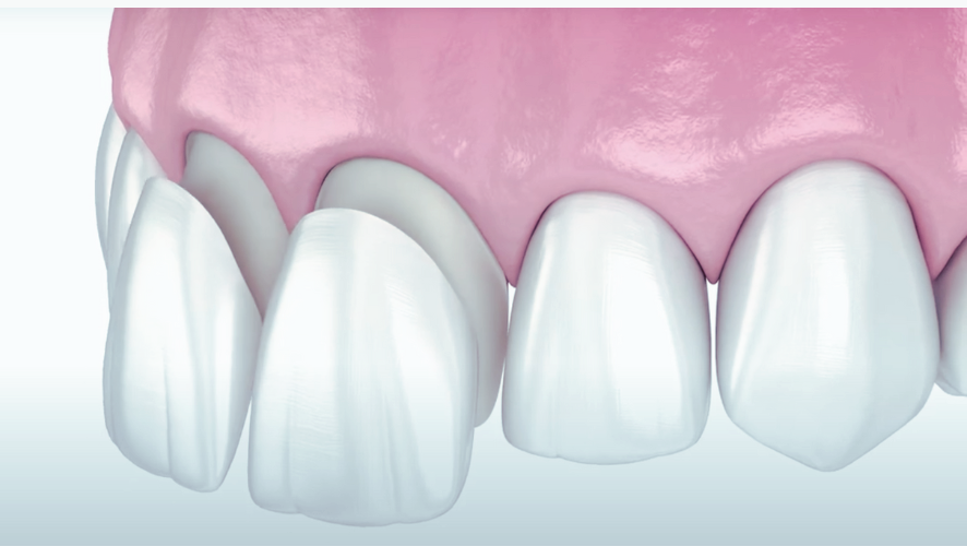 마곡역치과_3. 무삭제 라미네이트(디아네이트) 시술 과정 관련 이미지 8