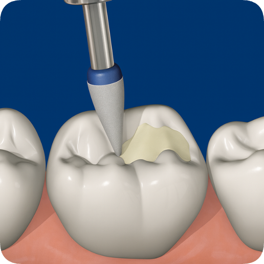 마곡역치과_ 4. 글래스아이오노머(GI) 충치 치료 과정 관련 이미지 5
