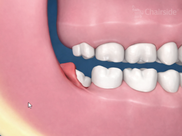마곡역치과_3. 사랑니 염증 반복되는 이유, 치료해도 다시 불편해질까요? 관련 이미지 3