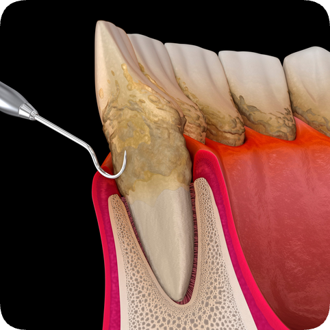 마곡동 치과_5. 치주질환 치료, 어디까지 해봤니? 단계별 잇몸 관리 총정리 관련 이미지 3