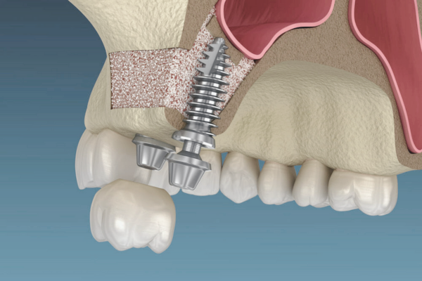 마곡치과_4. 위턱 임플란트 전 필수 체크! 상악동거상술 비용 관련 이미지 3