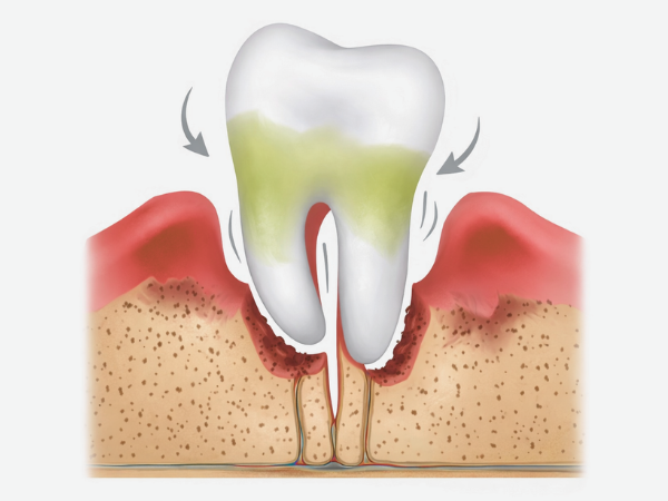 [마곡동치과_치아 흔들림 시리즈 4] 흔들리는 이빨, 어느 정도면 발치를 고려해야 할까요? 관련 이미지 4