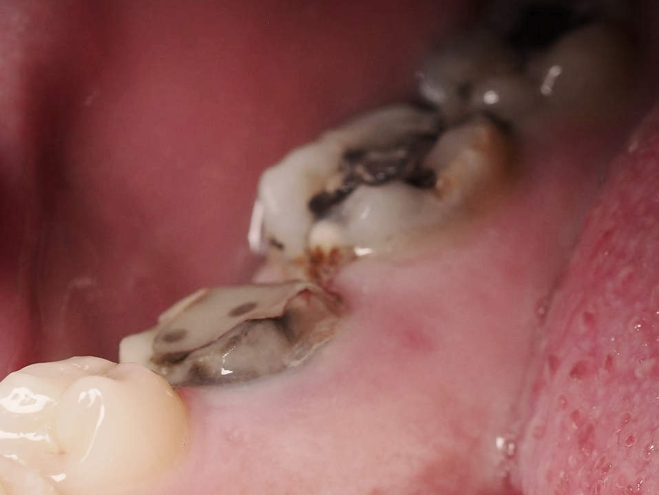 마곡치과_2. 오래된 아말감, 언제 교체해야 할까요? 꼭 확인해야 할 5가지 신호 관련 이미지 3