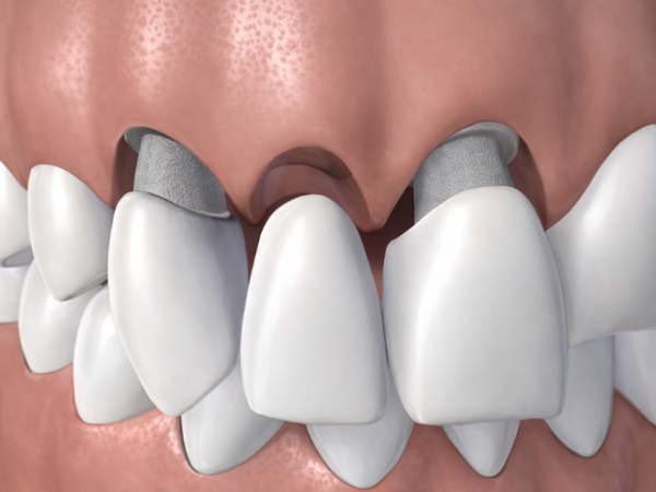 마곡역치과_2. 브릿지 치료, 누가 하면 좋을까요? 가능한 경우와 판단 기준 정리 관련 이미지 3