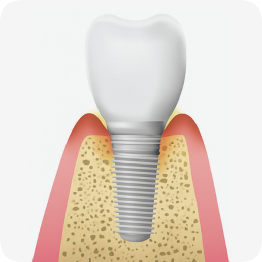 마곡동치과_"조용히 시작해 결국 흔들리는 이유" [ 3. 임플란트 주위염 진행 과정 ] 관련 이미지 2