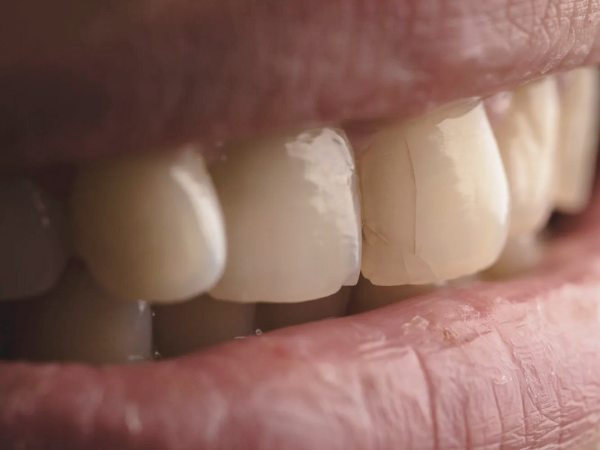 마곡역치과_&ldquo;겉은 멀쩡한데 왜 찌릿할까?&rdquo;  [1. 치아 금(균열) 생기는 이유 ] 관련 이미지 1