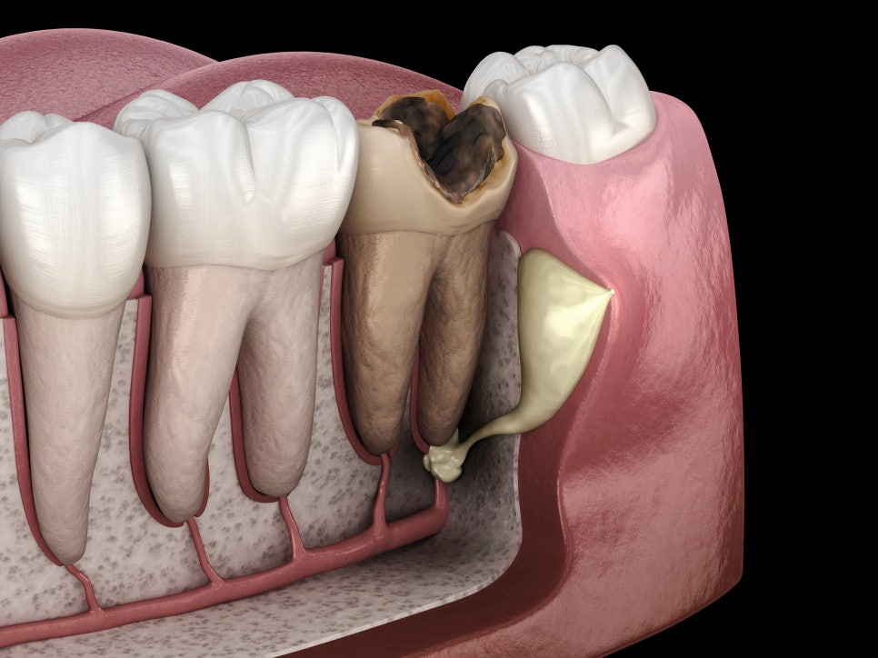 마곡동치과_ &ldquo;이상하네? 이거 혹시 충치?&rdquo;[2. 충치 증상 체크리스트] 관련 이미지 10