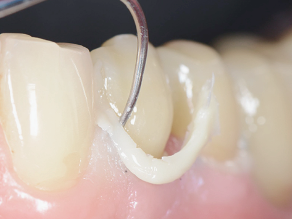 마곡역치과_ "보철물 씌웠다고 끝? 진짜 관리는 지금부터!" [ 4. 신경치료 후 크라운 관리법 ] 관련 이미지 1