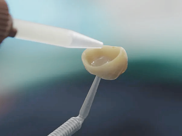 마곡역치과_5. 크라운 보철물 손상과 탈락, 원인과 치료 관련 이미지 5