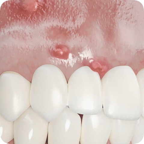 마곡동치과_3. 치주질환 자가진단 체크! 내 잇몸은 안전할까? 관련 이미지 6