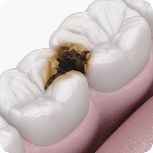 마곡동치과_1. 인레이 보철 치료, 언제 필요한가요?[ 치료 시기와 증상 정리 ] 관련 이미지 7