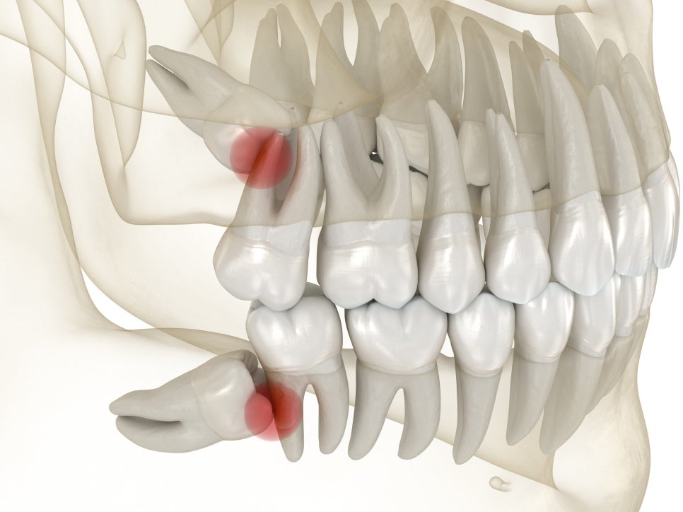 마곡동치과_1. 사랑니, 가장 늦게 가장 깊이 나는 치아? 위치와 맹출 시기 총정리 관련 이미지 1