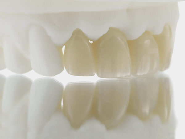 마곡동치과_2. 치과 크라운 보철의 종류별 장단점과 비용 관련 이미지 5