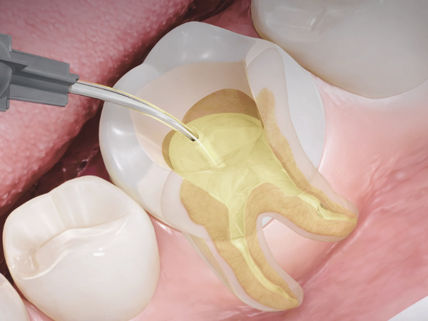 마곡치과_3. 재신경치료 과정, 신경치료 후 다시 아플 때 어떻게 진행될까요? 관련 이미지 3