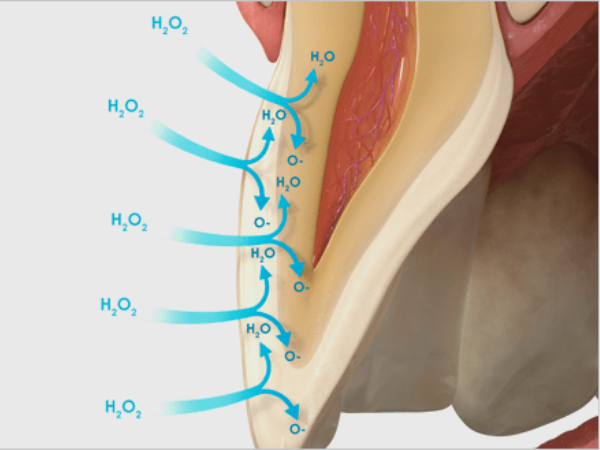 마곡역치과_ 하얀 치아로 가는 가장 빠른 길! [ 3. 생활치 전문가 미백의 특징과 과정 ] 관련 이미지 1