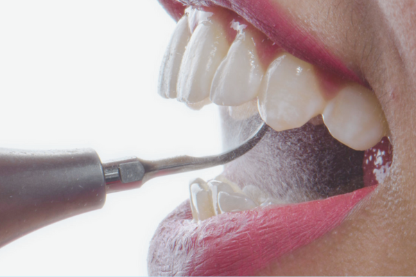 마곡역치과_ &ldquo;집에서 하얀 치아 만들기!&rdquo;[3. 생활치 자가미백 치료 특징과 과정 ] 관련 이미지 4